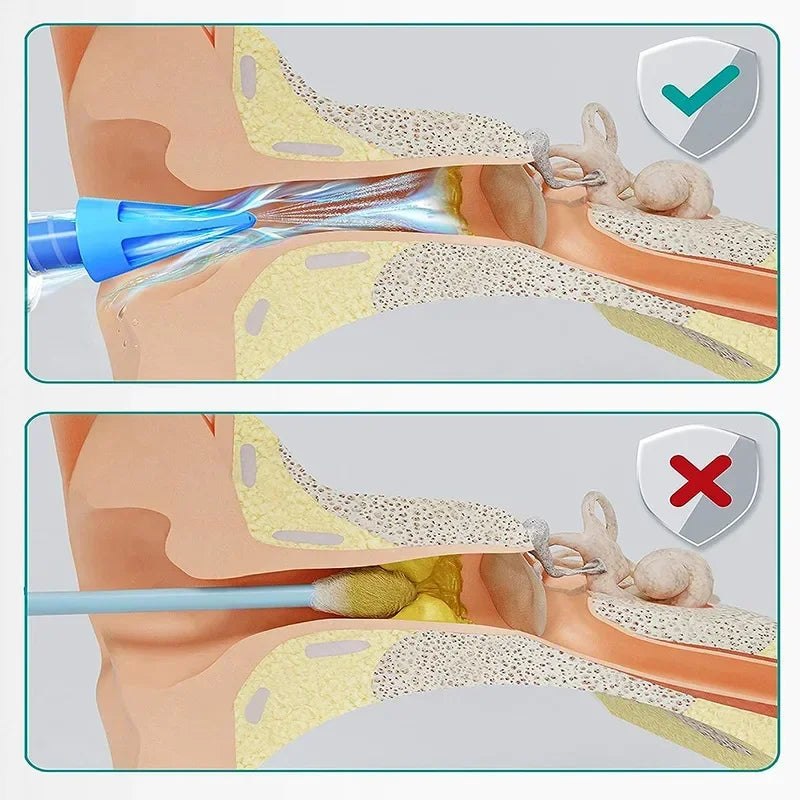 Ear Cleaner Irrigation Kit Ear Wax Removal Tool Water Washing Syringe Comfortable Unique 12/20ML Health Care